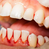 Gum Disease? 5 Signs Your Mouth Is Warning You Of Gum Disease!