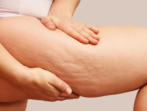 RITENZIONE IDRICA: COME AFFRONTARLA?