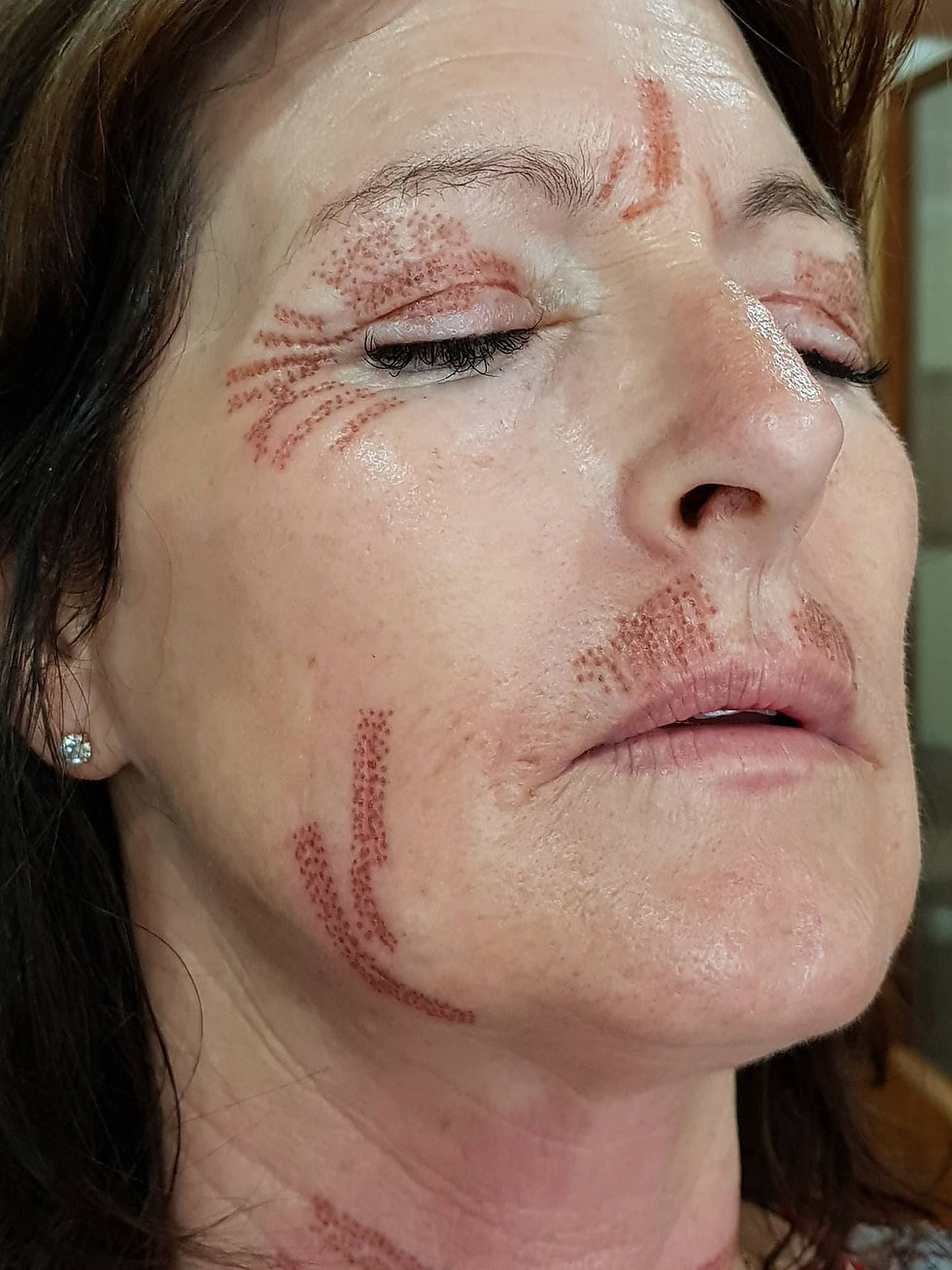 General skin tightening