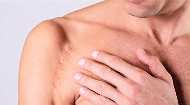 Post48-Scars-Treatment_edited_edited.jpg