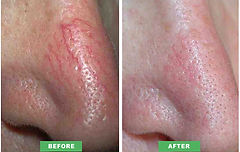 facial-vein.jpg
