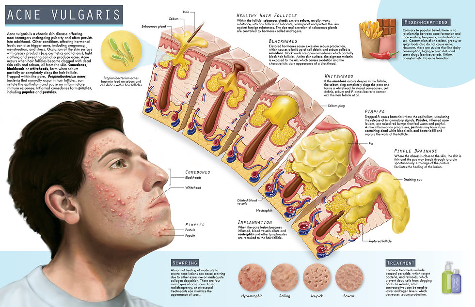 Editorial illustration of Acne Vulgaris Pathology
