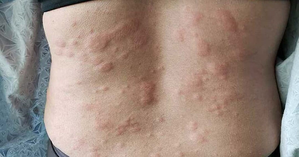 Person-with-severe-hives-on-back-1080x567-1.jpg