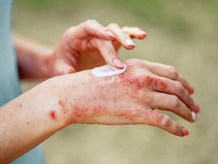 atopic-dermatitis-on-hands