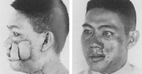 Salah satu operasi bedah yang dilakukan di zaman kolonial untuk pengangkatan kanker di pipi pasien.