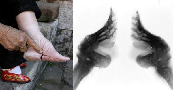 Ilustrasi Sepatu Bebat Kaki