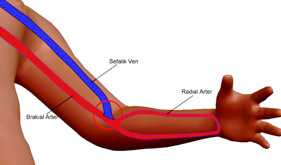 a v fistullerin siniflandirilmasi