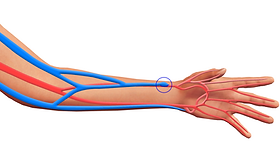 Arteriovenöz fistül