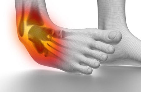 Ankle Sprain Survival Guide: What to Do