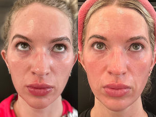 Under‑Eye Rejuvenation with PDGF+: The Future of Bright, Youthful Eyes