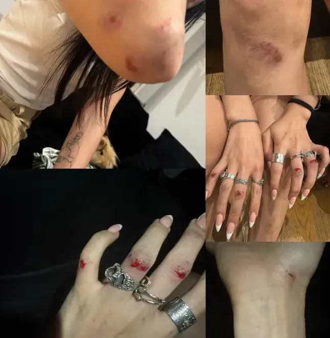 Jaylin shows some of the cuts and bruises she suffered in the attack at the hands of two strangers who screamed abuse (Photo: @jaylinye_)