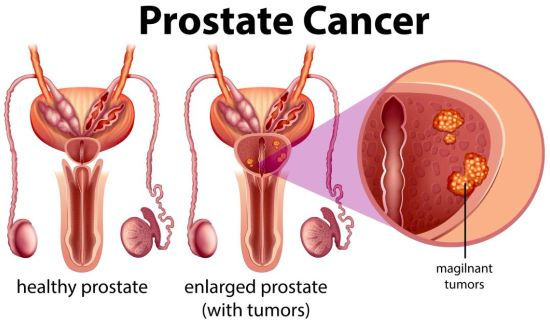 Prostate Cancer And Enlargement: What Every Man Needs To Know 
