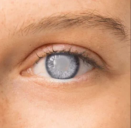 Glaucoma: Causes, Symptoms, Prevention & Treatment