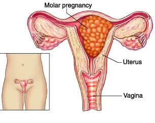 Molar Pregnancy
