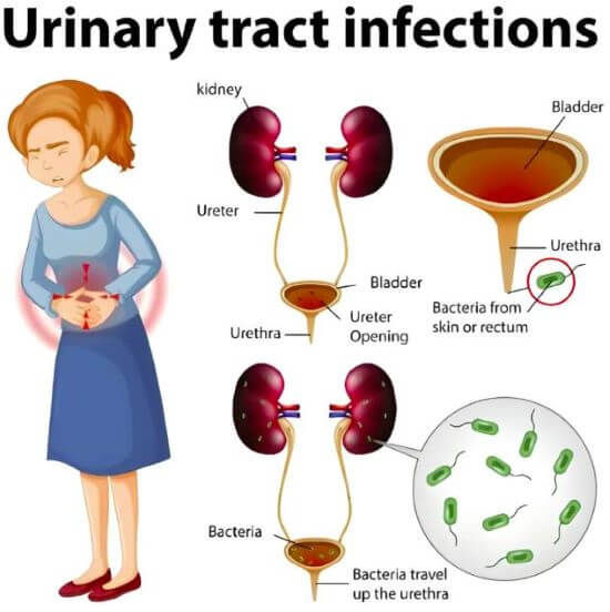 A picture of a person with UTI infection