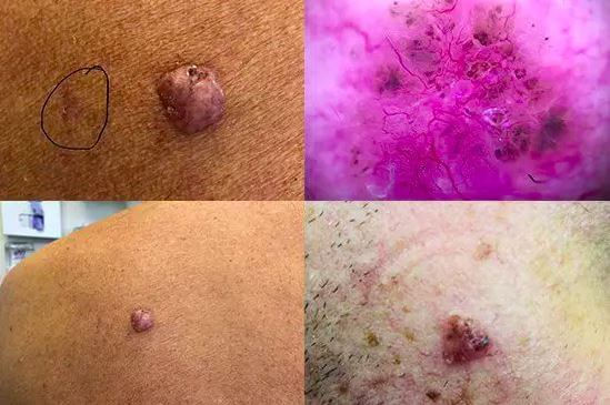 Everything You Need To Know About Skin Cancer