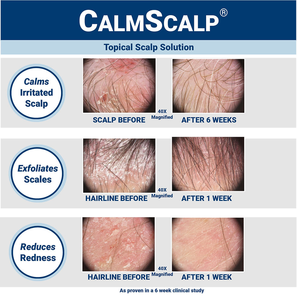 Thumbnail: CalmScalp Topical Scalp Solution
