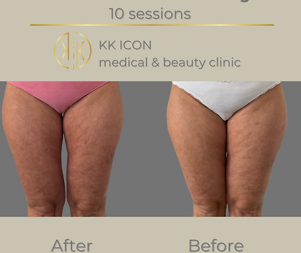 IBS 10 min of LPG massage.zip - 2 (1).PNG