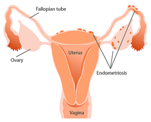 300px-Endometriosis.gif