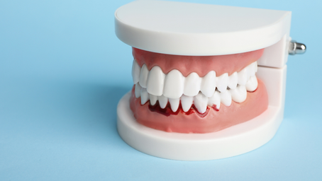 What Your Bleeding Gums Are Trying to Tell You