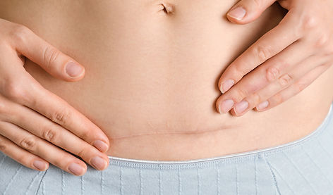 close-up-woman-s-abdomen-after-cesarean-section-year-later-healing-scar-after-surgery.jpg