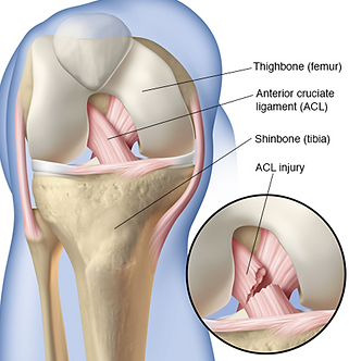 Knee Anterior Cruciate Ligament (ACL) tear. Nick Howells Consultant Knee Surgeon and Sports Injury Specialist