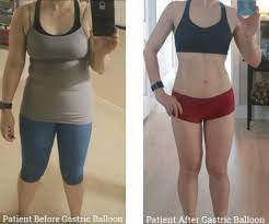 Bariatric Surgery in Dubai