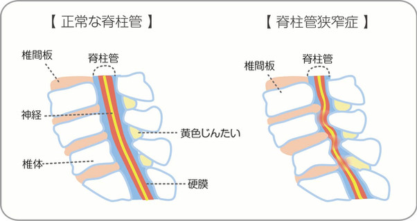 狭窄症の図