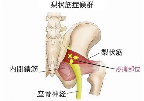 梨状筋症候群の図