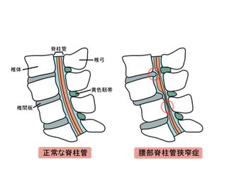 脊柱管狭窄症の図