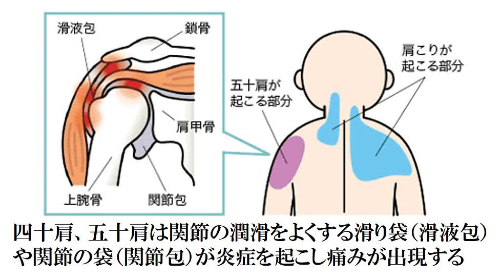 四十肩・五十肩が起こる仕組み