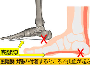 足底腱膜炎が重症化するとどうなる？症状と治療、重症度チェック