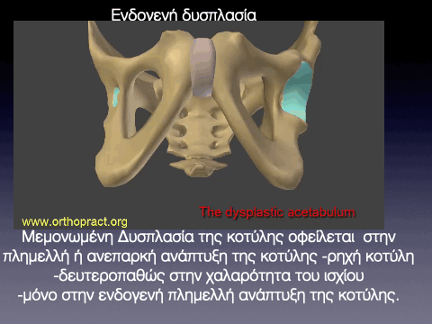 Πορεία Στο τελικό στάδιο η κοτύλη μπορεί να πάρει σχήμα όμοιο με αυτιού σκύλου. Η κεφαλή του μηριαίου κατά την έξοδο της από την κοτύλη περιγράφει μια τροχιά προς τα πλάγια, πάνω και πίσω. Από την στιγμή που η κεφαλή του μηριαίου εγκαταλείψει την κοτύλη, ο χόνδρος αυτής στερείται την αυξομειωμένη πίεση, την αναγκαία για την θρέψη, διαφοροποίηση και την λειτουργική προσαρμογή αυτού. Ο αρθρικός χόνδρος ατροφεί, η κοτύλη προοδευτικά γίνεται αβαθής και καθυστερεί στην ανάπτυξη. Στη νέα θέση της μηριαίας κεφαλής δημιουργείται μια λειτουργικά ανεπαρκής δευτερογενή κοτύλη.Με την μετανάστευση της μηριαίας κεφαλής προς τα επάνω, ο στρόγγυλος σύνδεσμος επιμηκύνεται, τα αγγεία που ευρίσκονται μέσα σ'αυτόν πιέζονται ή αποφράσσονται τελείως, ο αρθρικός θύλακας επιμηκύνεται σαν σαμπρέλα, μπορεί επίσης να συμφύεται στο λαγόνιο και στην περιοχή της πρωτογενούς κοτύλης,να είναι συρρικνωμένος και να αποτελεί εμπόδιο ανάταξης. Η ανάταξη μπορεί επίσης να εμποδίζεται από τον ανεστραμμένο επιχείλιο χόνδρο,