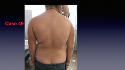 SCOLIOSIS WORIKING DEMO .057.jpeg
