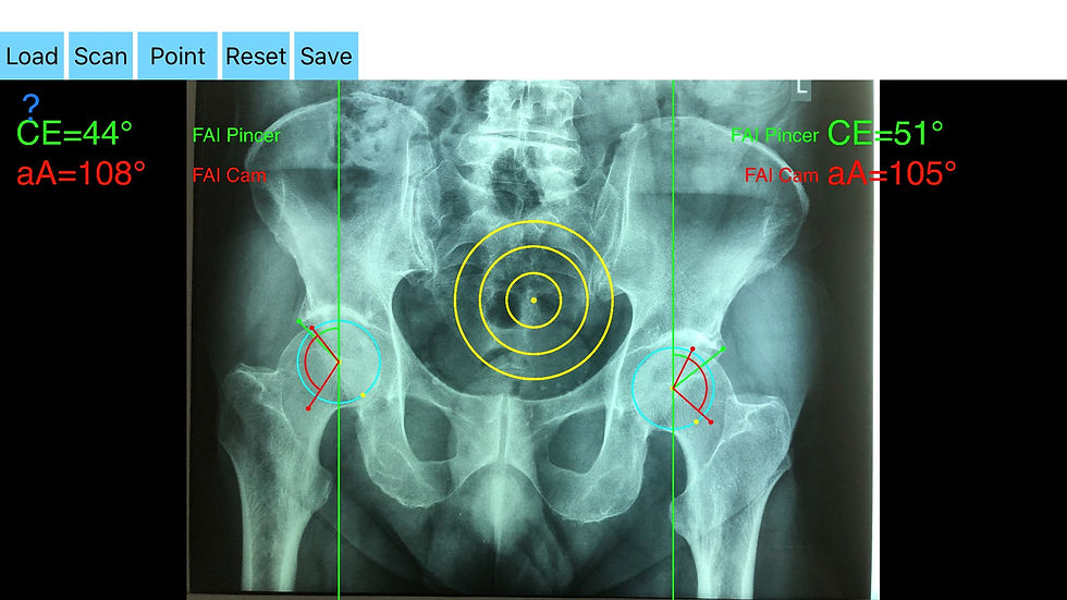 Femoral Acetabular Impingement App