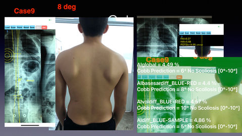 19 SCOLIOSIS WORIKING DEMO .050.jpeg