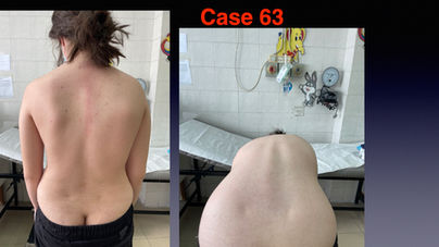 SCOLIOSIS WORIKING DEMO .062.jpeg