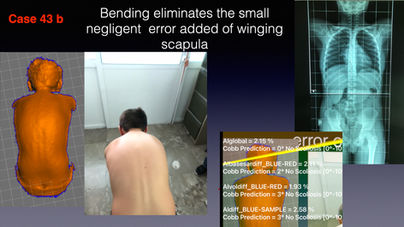 SCOLIOSIS WORIKING DEMO .069.jpeg