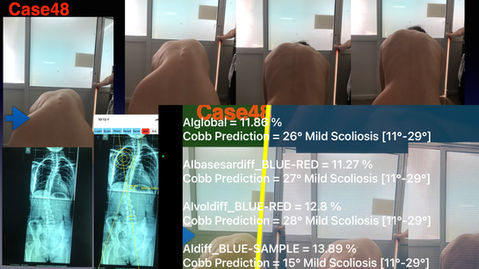 12 SCOLIOSIS WORIKING DEMO .048.jpeg