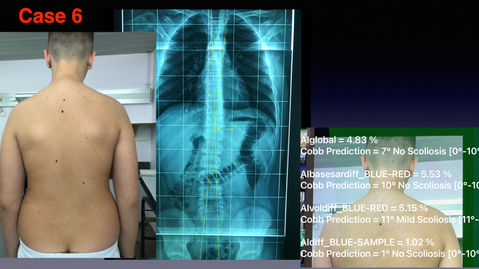 16 SCOLIOSIS WORIKING DEMO .044.jpeg