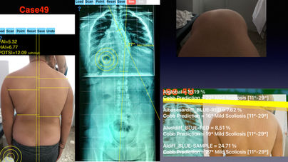SCOLIOSIS WORIKING DEMO .058.jpeg