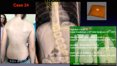 SCOLIOSIS WORIKING DEMO .064.jpeg