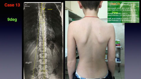 20 SCOLIOSIS WORIKING DEMO .052.jpeg