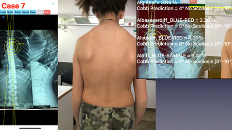 18 SCOLIOSIS WORIKING DEMO .049.jpeg
