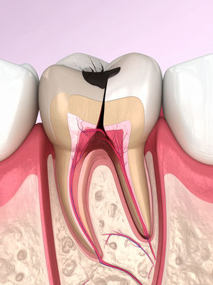 When a Tooth Nerve Becomes Infected (Root Canal)