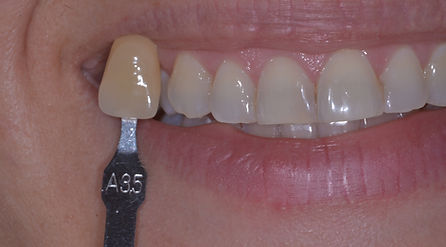 Teeth Whitening