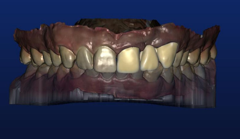 High Translucent Zirconia Crown