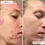 Thumbnail: Omnilux Clear - Light Therapy Acne Treatment