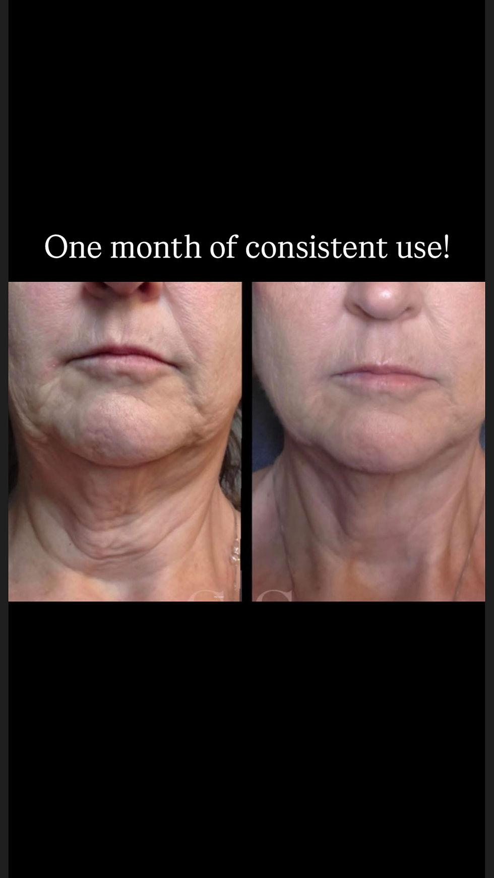 Thumbnail: Neck Lift Intensive Firming Neck Cream by KrX Aesthetics