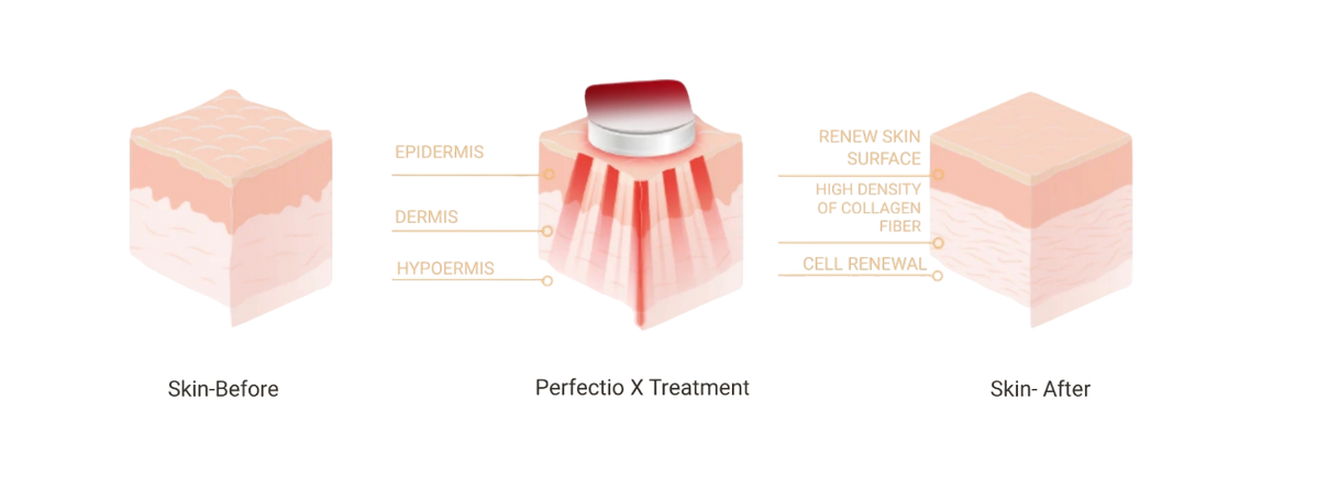 Perfectio X treatment imgage PNG.png